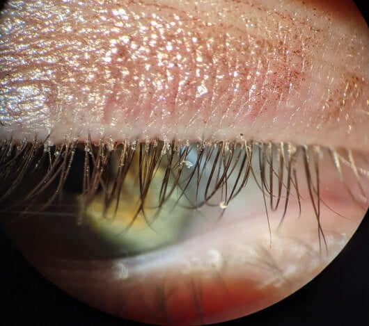closeup of eyelid and eyelashes afflicted with crusties also known as collarettes