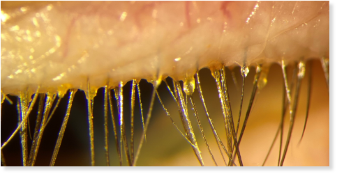 closeup of eyelid and eyelashes afflicted with demodex blepharitis db