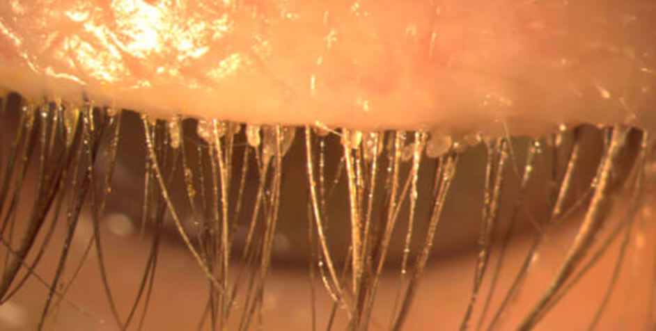 closeup of eyelid and eyelashes afflicted with crusties also known as collarettes